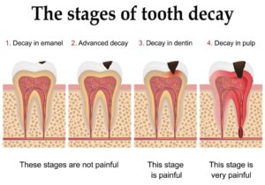 Dental Decay